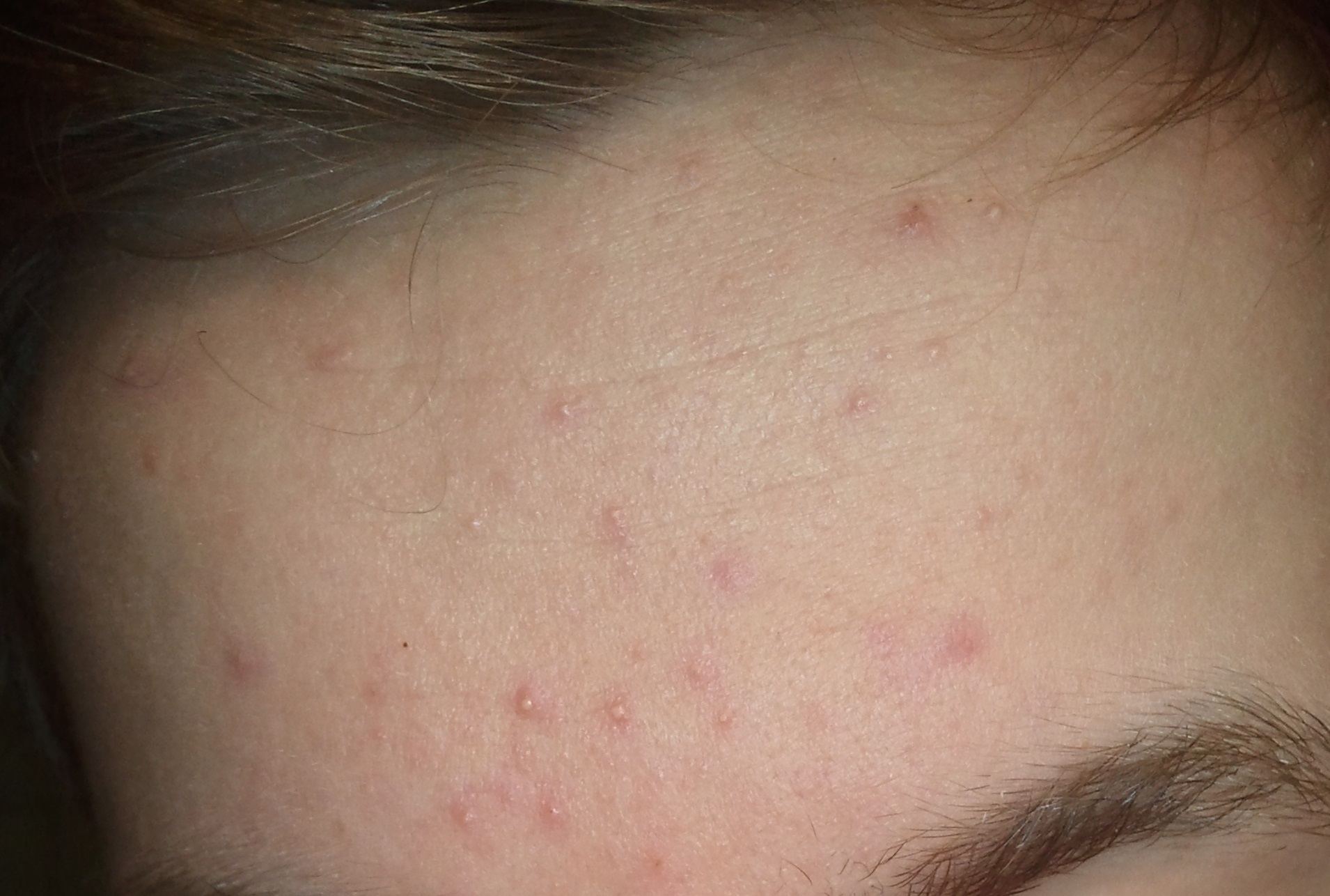 pickel an den schläfen pickel an den schläfen