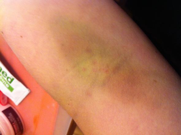 Hausmittel gegen blaue Flecken um Stichstellen?