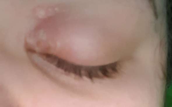 Hausmittel Gegen Entzundetes Auge Gesundheit Und Medizin Augen