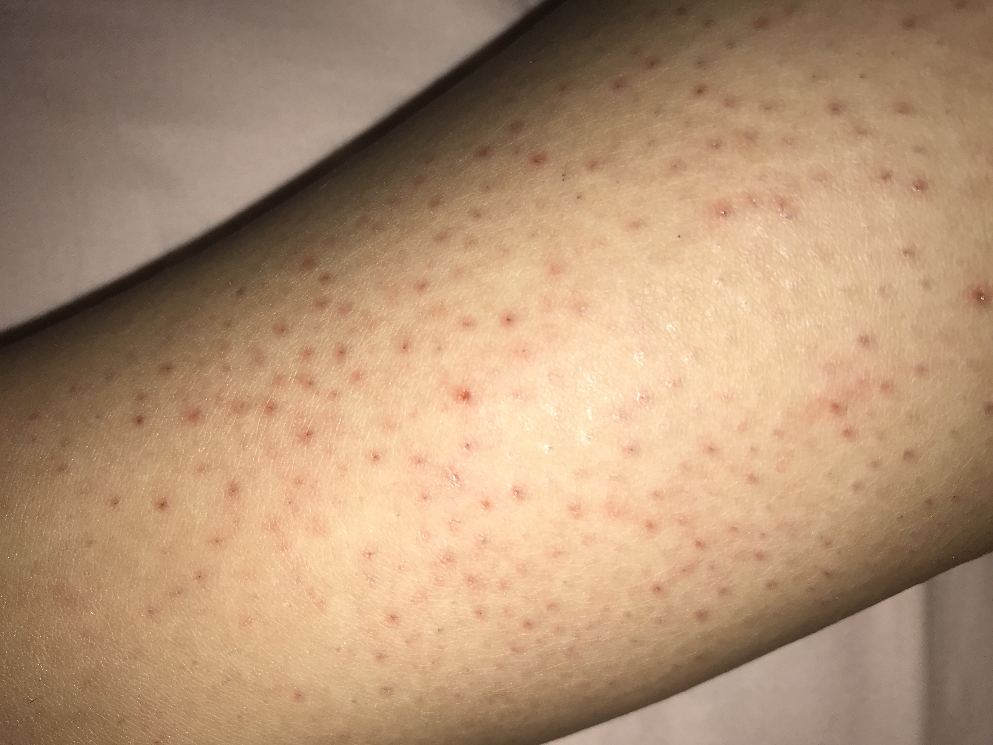 hausmittel gegen rote punkte nach der