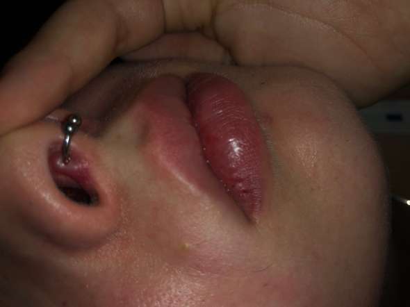 hausmittel gegen wildfleisch gesundheit und medizin piercing piercer