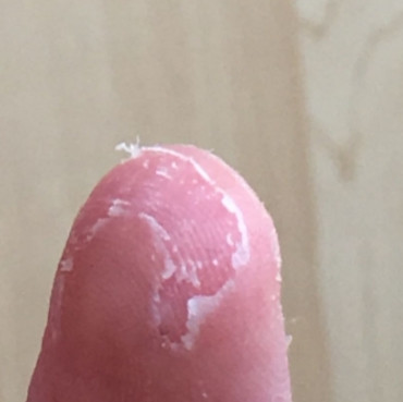 Haut ab Daumen “löst sich auf”? (Finger)