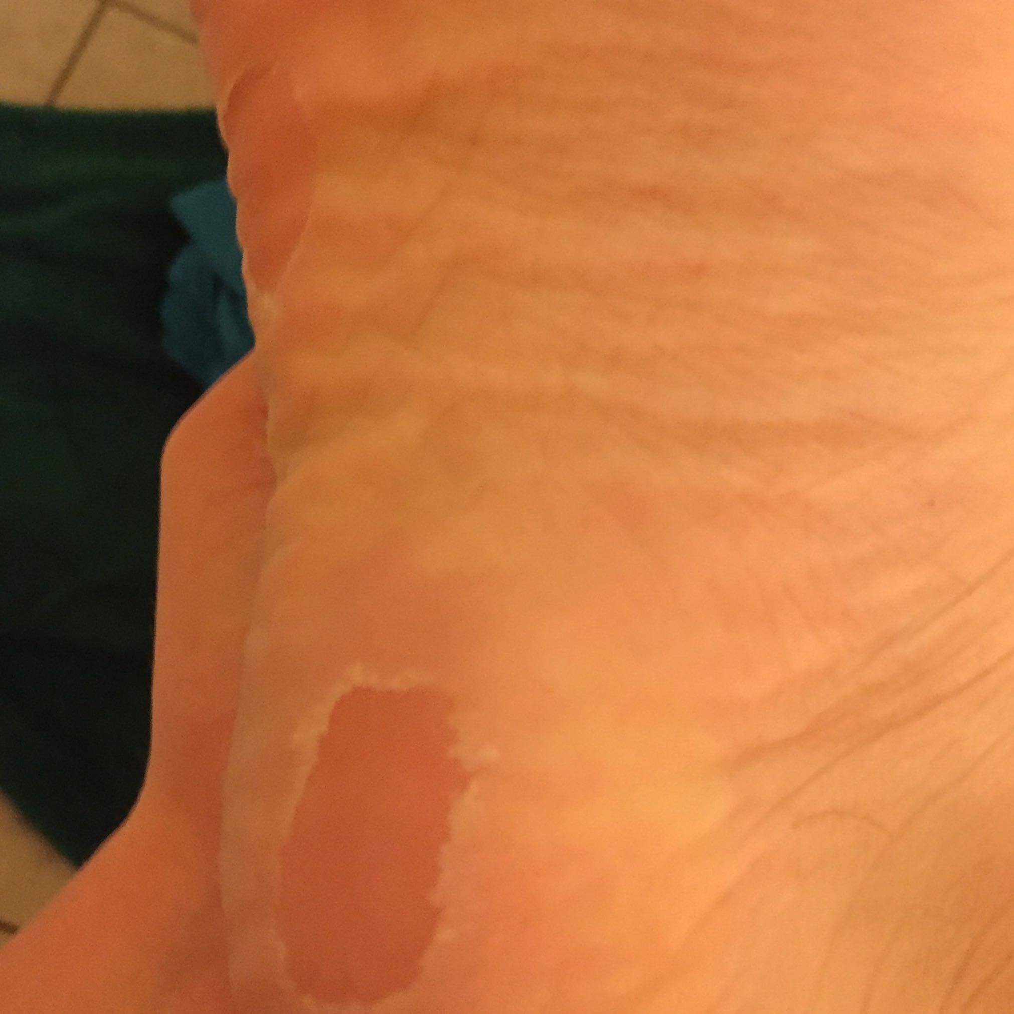 Haut am Fuß schält sich nach dem Baden? (Füße)