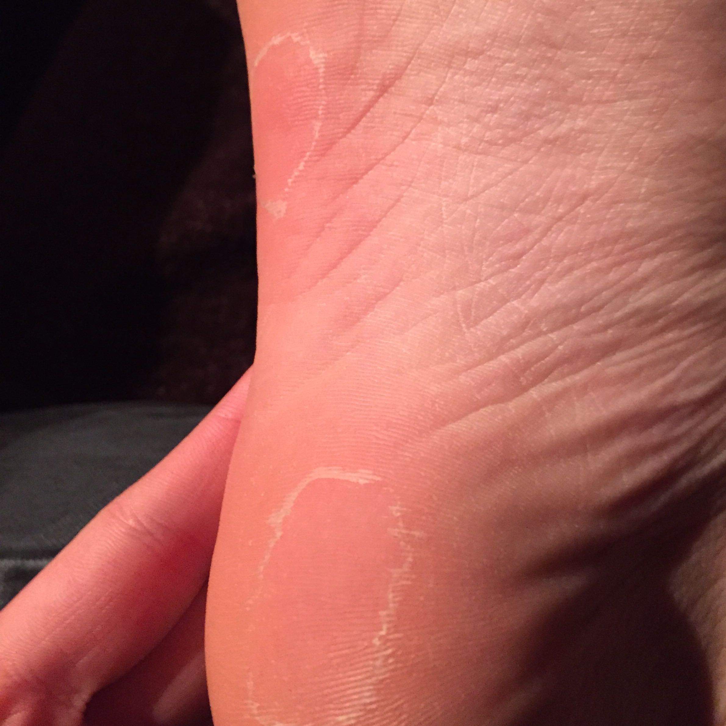 Haut am Fuß schält sich nach dem Baden? (Füße)