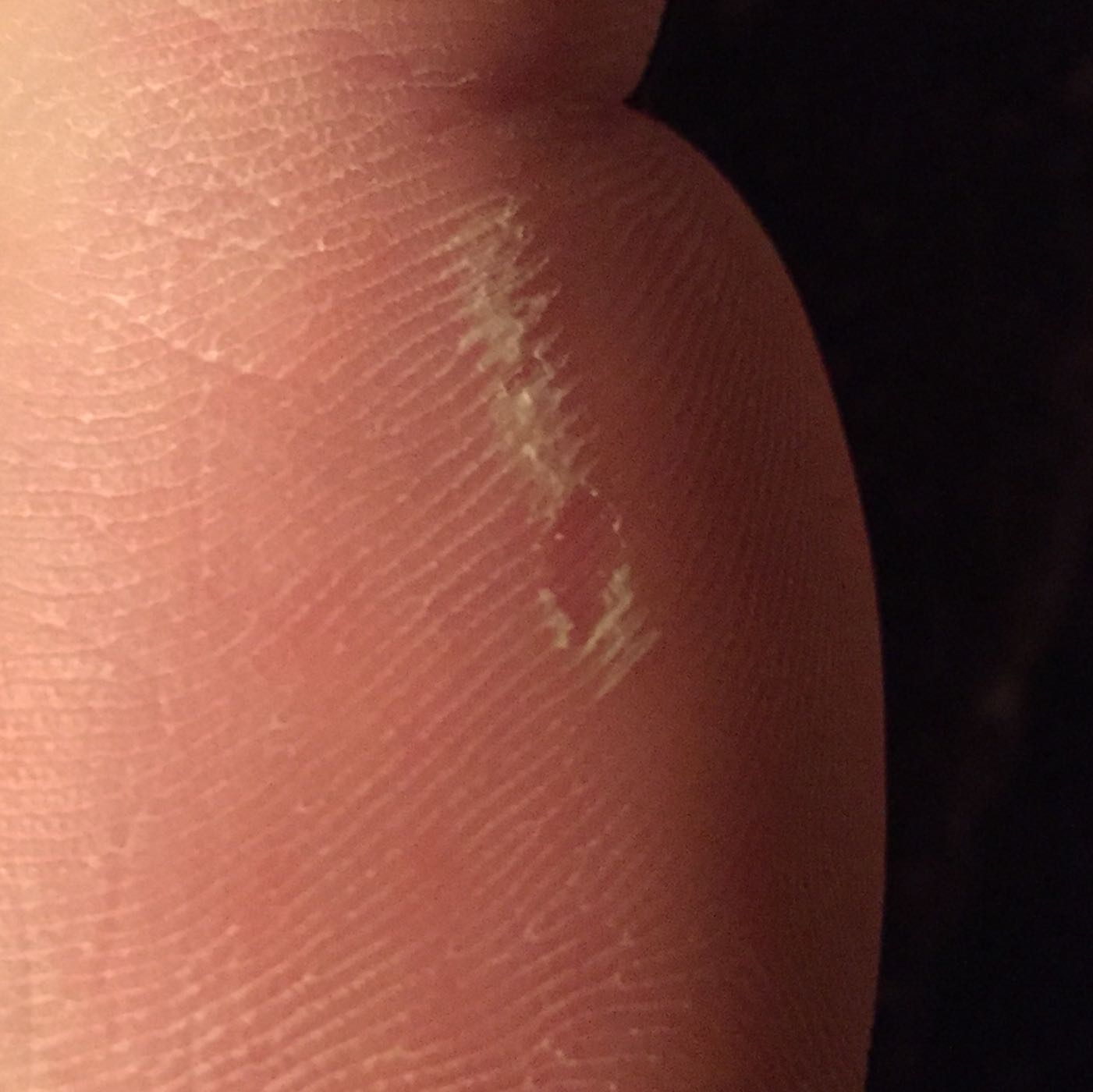 Haut am Fuß schält sich nach dem Baden? (Füße)