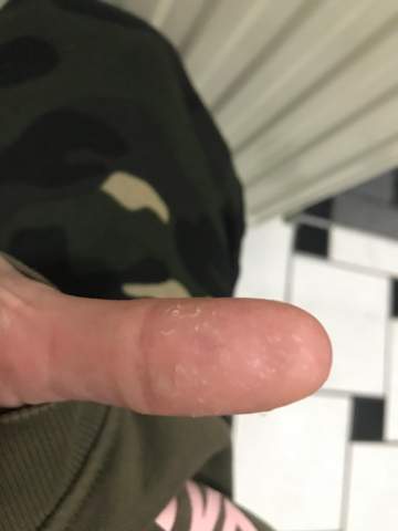 Haut an den Fingerkuppen löst sich?
