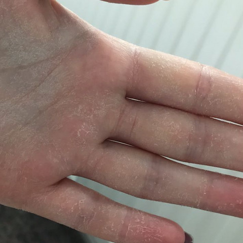 Haut An Den Handinnenflachen Pellt Sich Was Tun Gesundheit Und Medizin Hand Haut An Den Handinnenflachen Pellt Sich Was Tun Gesundheit Und Medizin Hand