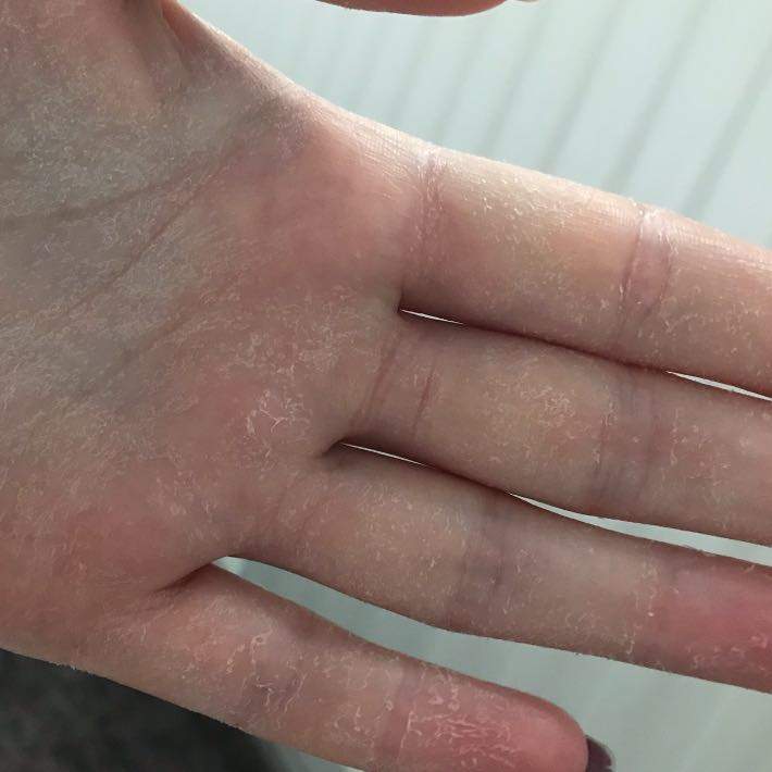 Haut an den Handinnenflächen pellt sich was tun? (Gesundheit und Medizin, Hand)