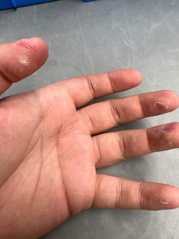 Haut an Fingern fällt ab?