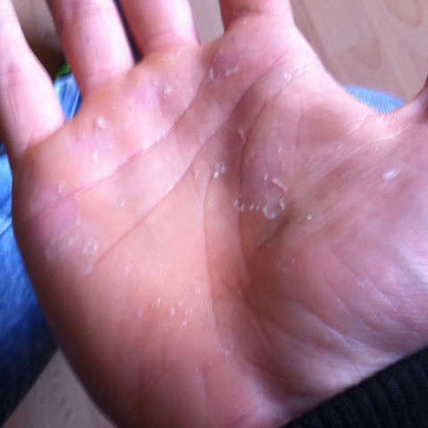 Haut An Handinnenflache Lost Sich Gesundheit Haut An Handinnenflache Lost Sich Gesundheit