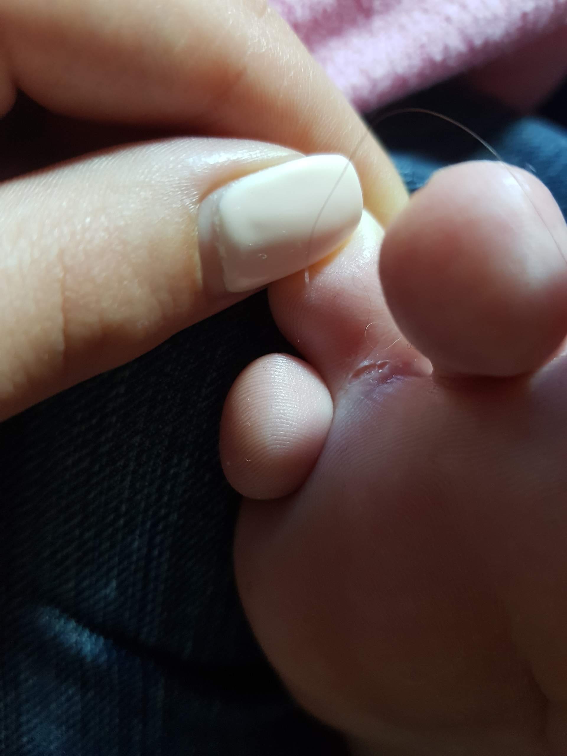 Haut An Zehen Reisst Auf Gesundheit Und Medizin Gesundheit Verletzung Haut An Zehen Reisst Auf Gesundheit Und Medizin Gesundheit Verletzung