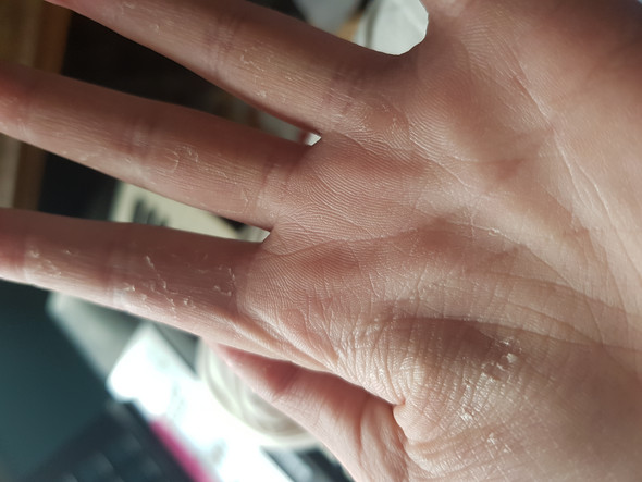 Haut Blattert Sich An Den Handen Ab Gesundheit Haut Blattert Sich An Den Handen Ab Gesundheit