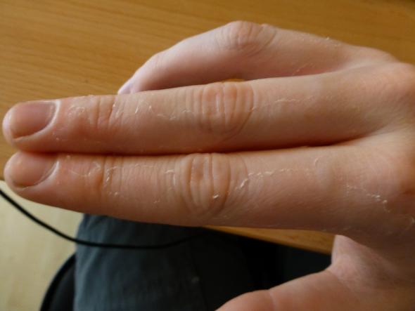 An allen drei Fingern häutet sich die Haut - (Arbeit, Medizin, Arzt)