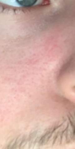 Haut Im Gesicht Rot Und Juckt Gesundheit Und Medizin Rotung