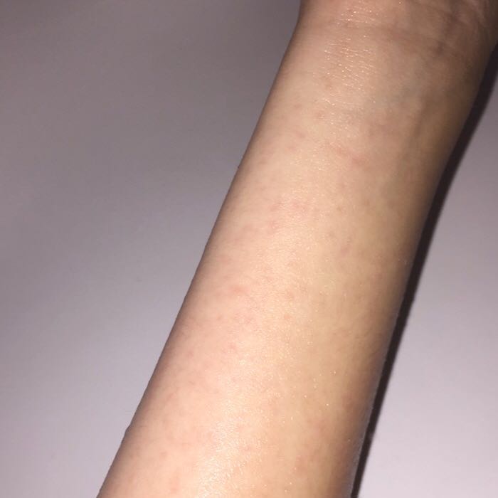 Haut immer rot nach den Duschen? (Ausschlag)