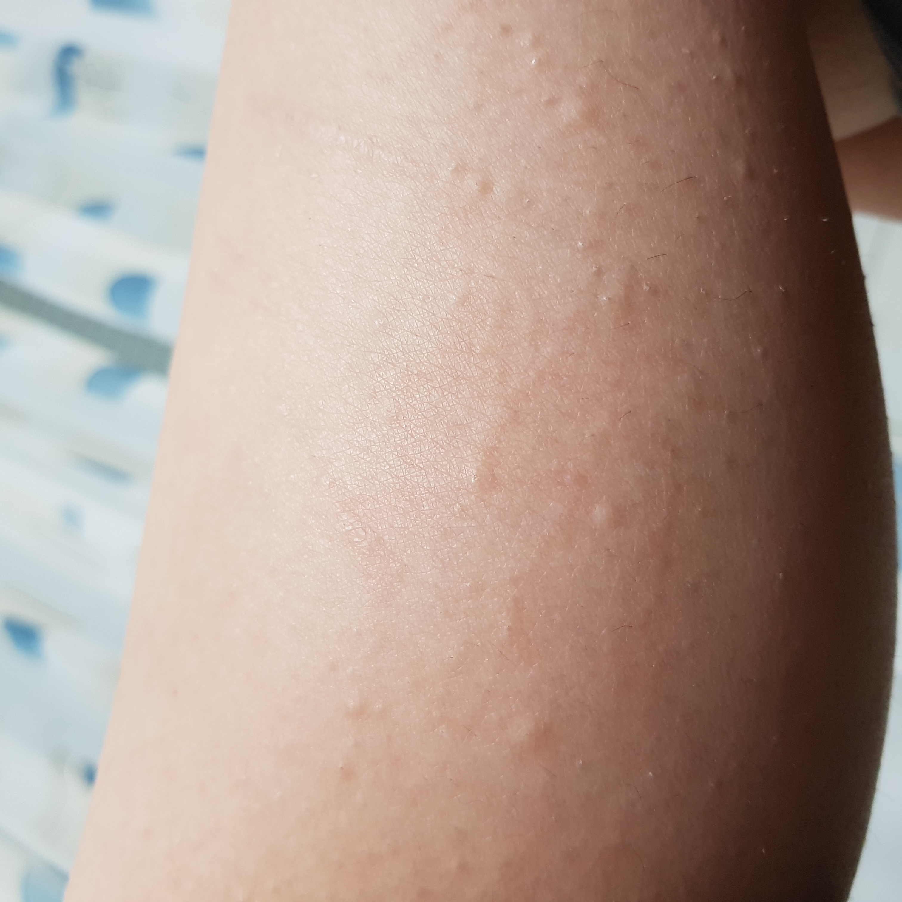 Haut juckt, kratzt und hat hautfarbene �Pickel�? (Gesundheit, Rasur