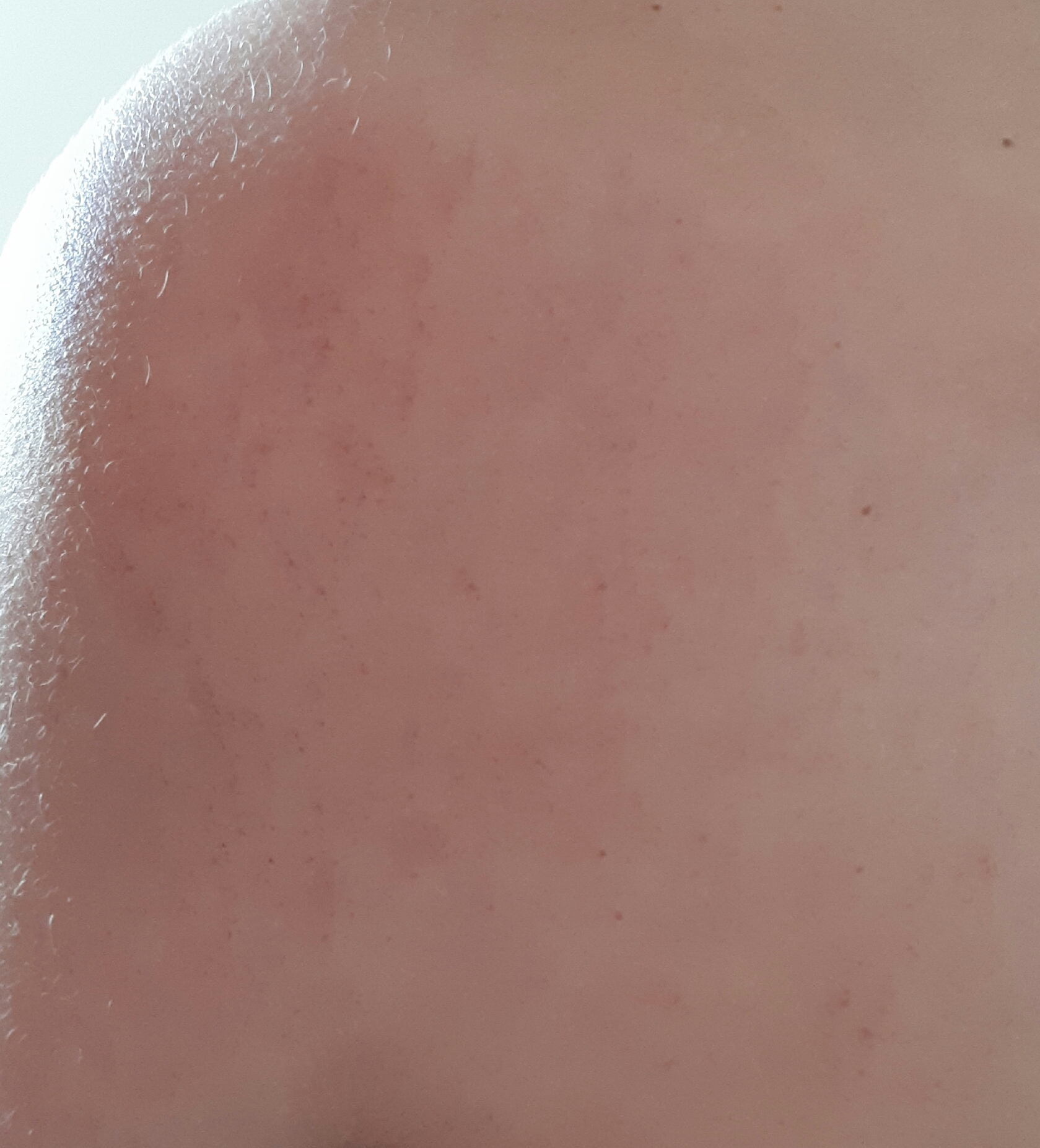 Haut juckt nach Meer? (Gesundheit, Gesundheit und Medizin, Ausschlag)