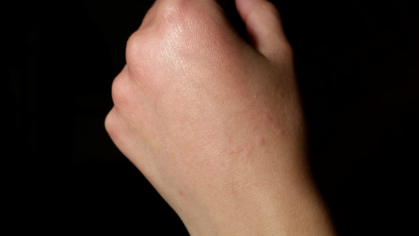 Haut Juckt Und Brennt An Meiner Hand Hilfe Gesundheit Und Medizin Brennen Jucken