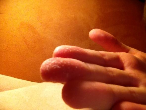 Hier diese Dinger auf meinem Finger - (Haut, Gips)