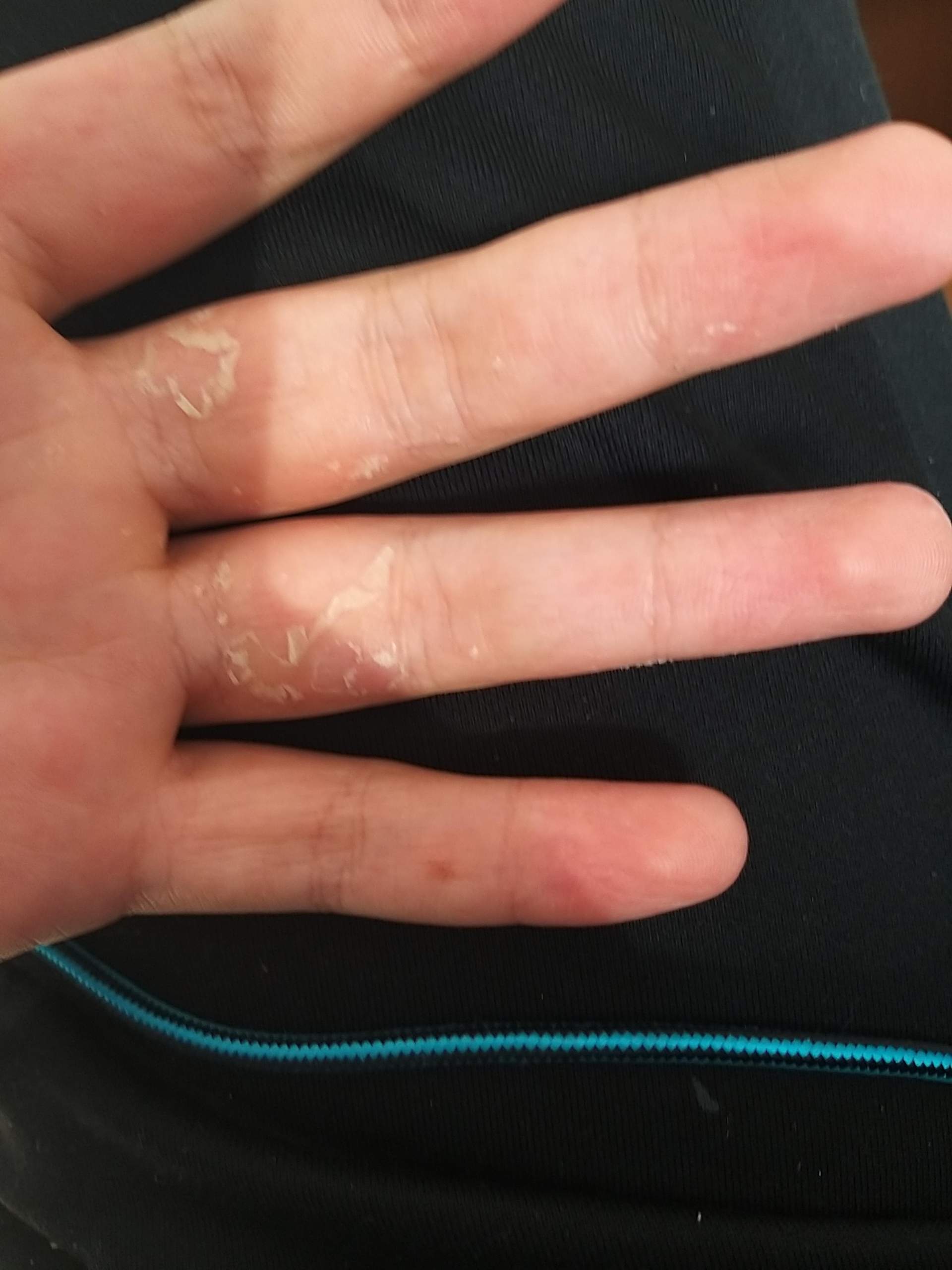 Haut Schalt Sich Ab Was Tun Gesundheit Und Medizin Arzt Hautpflege Haut Schalt Sich Ab Was Tun Gesundheit Und Medizin Arzt Hautpflege