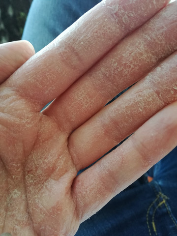 Haut Schalt Sich Schlimm An Den Handinnenflachen Gesundheit Und Medizin Hand Hautarzt Haut Schalt Sich Schlimm An Den Handinnenflachen Gesundheit Und Medizin Hand Hautarzt