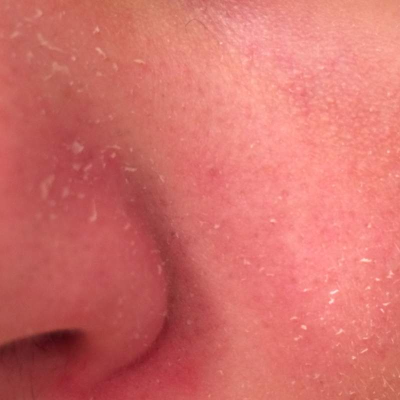 Trockene haut nase extrem Wachsender Ansturm: