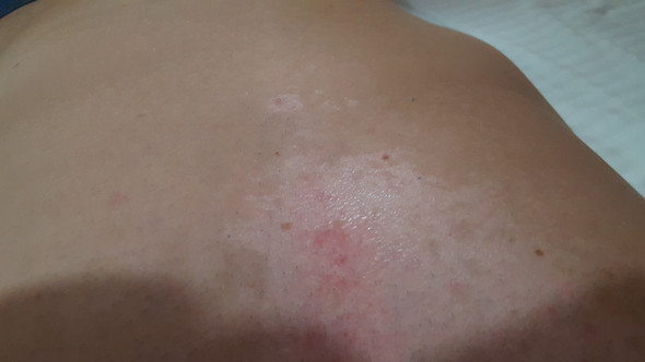 Haut Schalt Sich Weisst Flecken Was Kann Man Tun Um Die Braune Zu Behalten Sonne Sonnenbrand Haut Schalt Sich Weisst Flecken Was Kann Man Tun Um Die Braune Zu Behalten Sonne Sonnenbrand