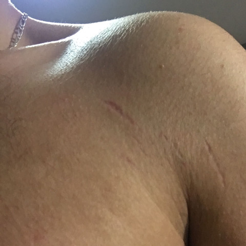 Sieht aus wie ne Narbe - (Fitness, Haut, Narben)
