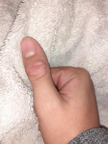Haut vom Finger geht weg?