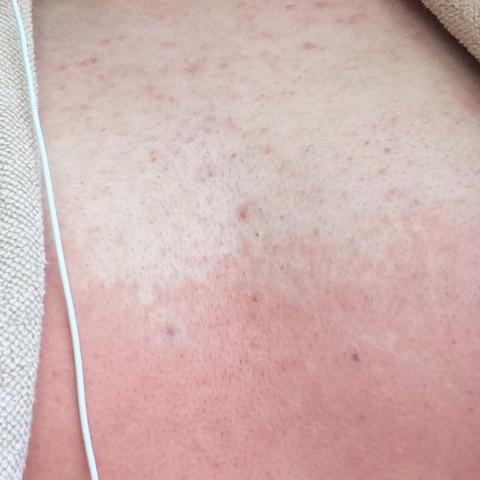 Haut Wird An Manchen Stellen Nicht Braun Woran Liegt Das Urlaub Sonne Flecken Haut Wird An Manchen Stellen Nicht Braun Woran Liegt Das Urlaub Sonne Flecken