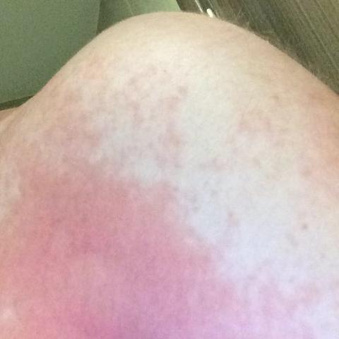 Haut Wird An Manchen Stellen Nicht Braun Woran Liegt Das Urlaub Sonne Flecken Haut Wird An Manchen Stellen Nicht Braun Woran Liegt Das Urlaub Sonne Flecken