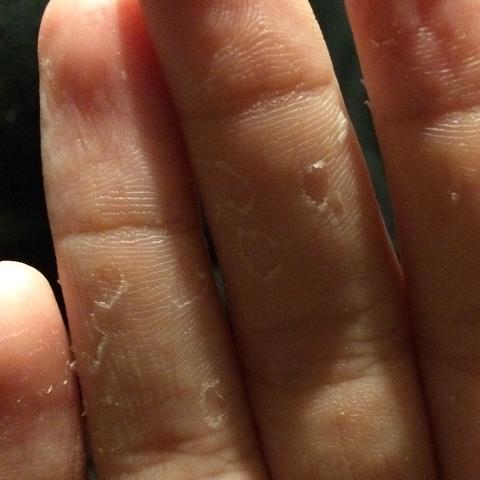 finger - (Krankheit, Allergie, Hand)