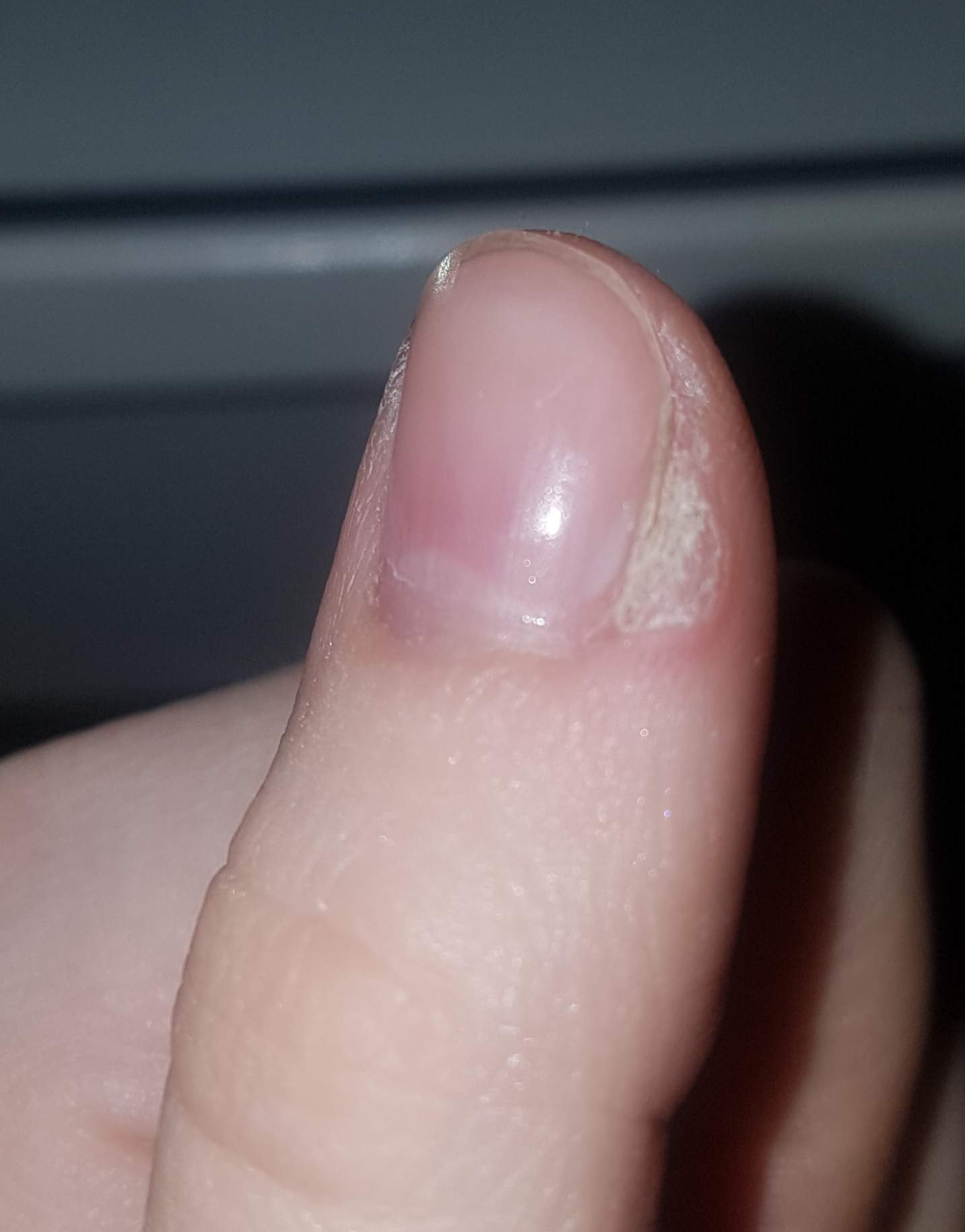 Hautansammlung/Hornhaut an der Nagelhaut? (Haut, Entzündung, Hautarzt)