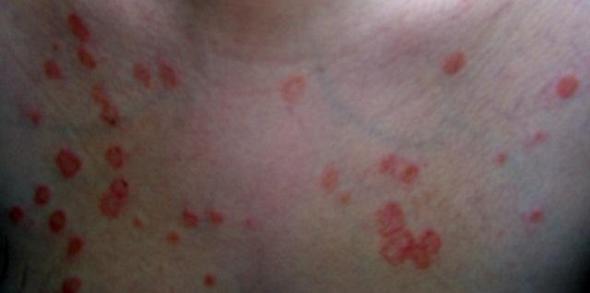 Virusinfektion Hautausschlag