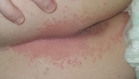 Hautausschlag Am After Gesundheit Und Medizin Brennen Hautausschlag Am After Gesundheit Und Medizin Brennen