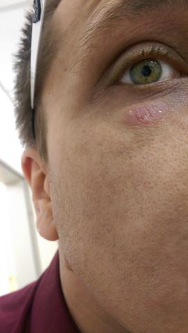 Hautausschlag Am Arm Und Unterm Auge Angst Um Hiv Ausschlag Hautausschlag Am Arm Und Unterm Auge Angst Um Hiv Ausschlag