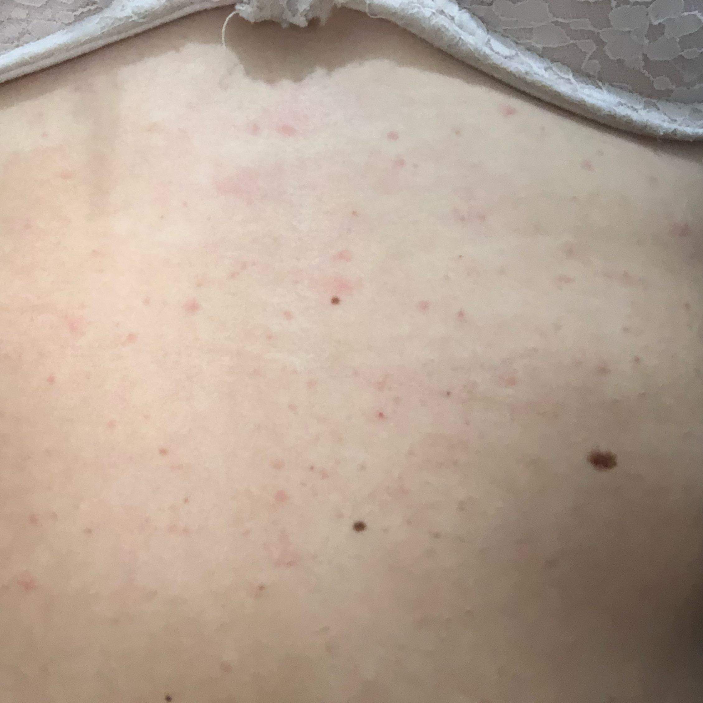 Hautausschlag am Bauch, Hilfe? (Gesundheit und Medizin, Krankheit, Haut)