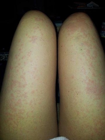 Hautausschlag Am Ganzen Korper Medizin Dermatologie Neurodermitis Hautausschlag Am Ganzen Korper Medizin Dermatologie Neurodermitis