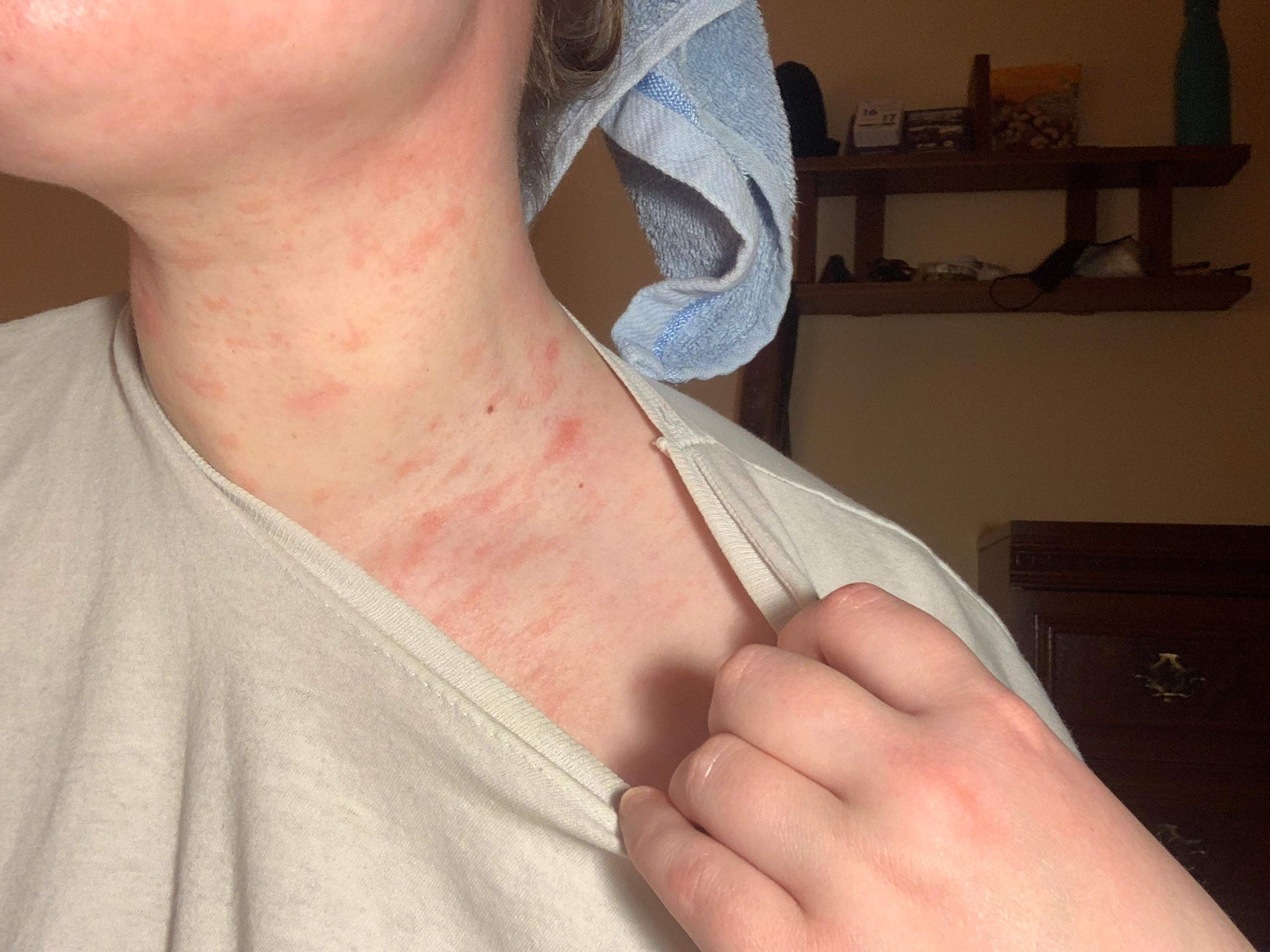 Hautausschlag Am Hals Und Dekoltee Was Kann Ich Tun Gesundheit Und Medizin Gesundheit Haut Hautausschlag Am Hals Und Dekoltee Was Kann Ich Tun Gesundheit Und Medizin Gesundheit Haut