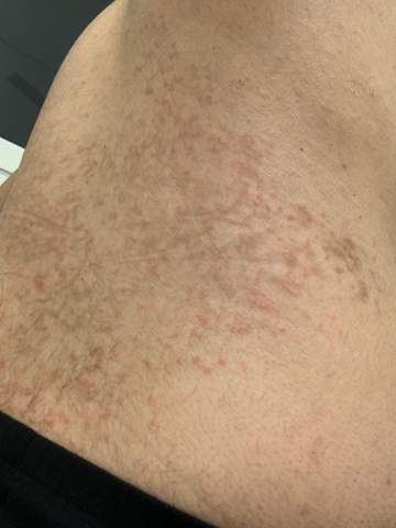 Hautausschlag Am Rucken Was Kann Das Sein Gesundheit Und Medizin Gesundheit Haut Hautausschlag Am Rucken Was Kann Das Sein Gesundheit Und Medizin Gesundheit Haut