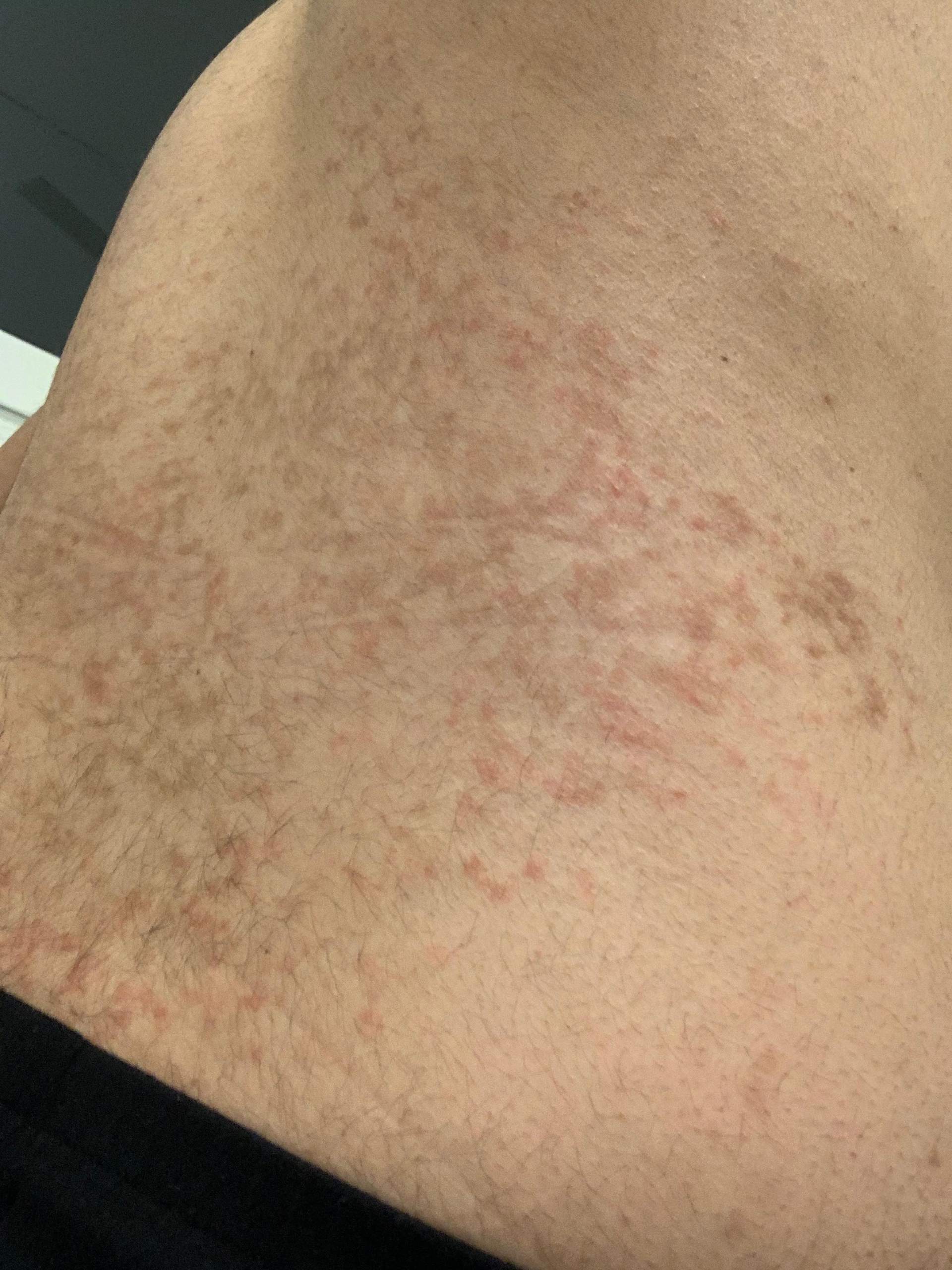 Hautausschlag Am Rucken Was Kann Das Sein Gesundheit Und Medizin Gesundheit Haut Hautausschlag Am Rucken Was Kann Das Sein Gesundheit Und Medizin Gesundheit Haut