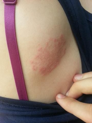 Hautausschlag Am Rucken Krankheit Haut Ausschlag Hautausschlag Am Rucken Krankheit Haut Ausschlag