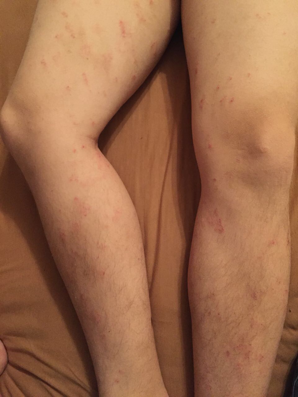 Hautausschlag An Beinen Und Armen Gesundheit Und Medizin Haut Jucken Hautausschlag An Beinen Und Armen Gesundheit Und Medizin Haut Jucken