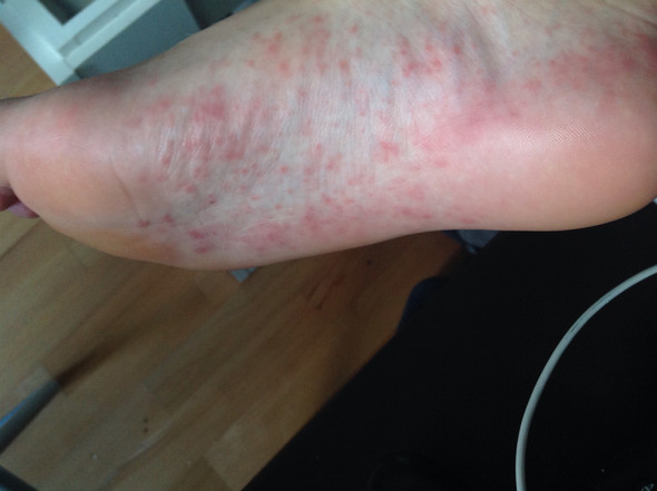 Hautausschlag An Handen Und Fussen Haut Ausschlag Hautausschlag An Handen Und Fussen Haut Ausschlag