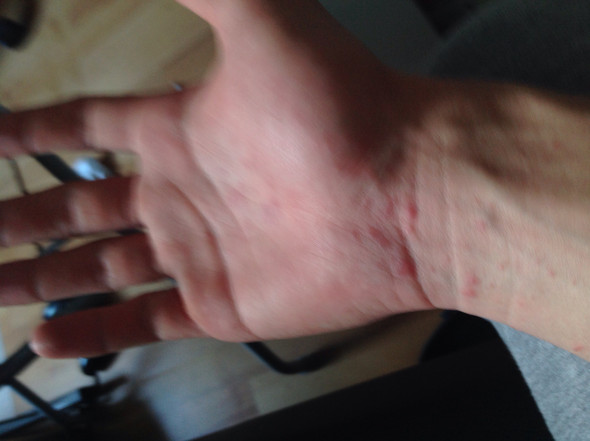 Hautausschlag An Handen Und Fussen Haut Ausschlag Hautausschlag An Handen Und Fussen Haut Ausschlag