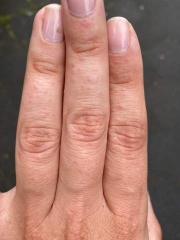 Hautausschlag An Handen Und Fussen Korper Krankheit Hautausschlag An Handen Und Fussen Korper Krankheit