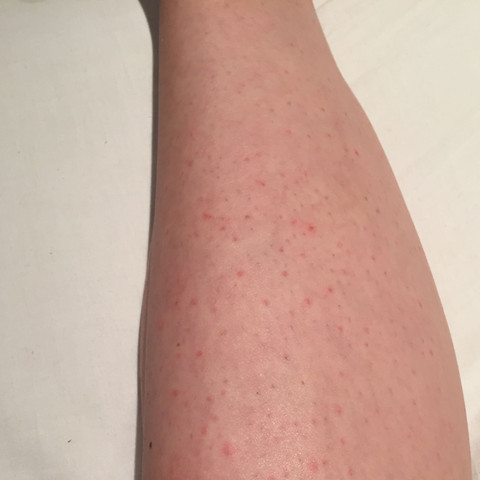 Hautausschlag An Schienbeinen Und Waden Gesundheit Medizin Haut