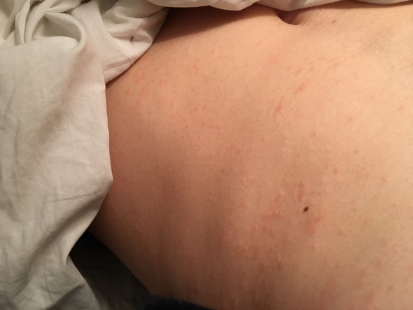 Hautausschlag Bauch Und Rucken Haut Ausschlag Hautausschlag Bauch Und Rucken Haut Ausschlag