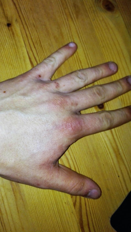 Hand - (Haut, Alkohol, Schnupfen)