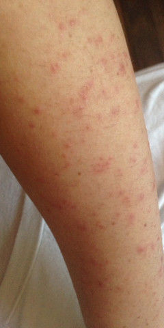 Hautausschlag Hautallergie Selbsthass Ich Weiss Nicht Mehr Weiter Akne Hautprobleme Neurodermitis Hautausschlag Hautallergie Selbsthass Ich Weiss Nicht Mehr Weiter Akne Hautprobleme Neurodermitis